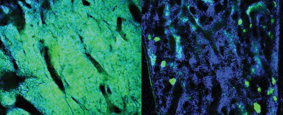 Two microscopy images of the bone marrow.