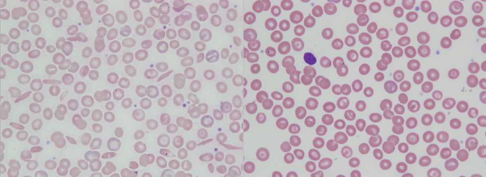 Two microscopy images of blood cells.